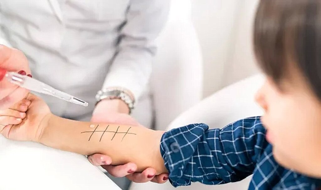 Alerjik hastalıklarda Deri Prick testi nedir?