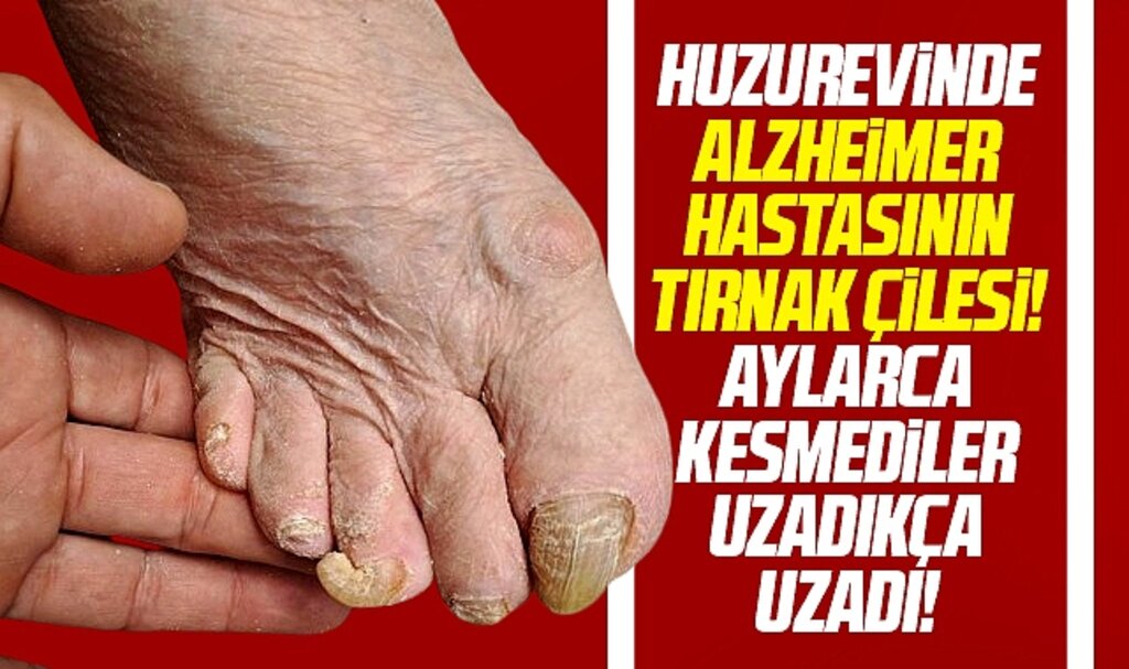 Samsun'da huzurevinde kalan yaşlı adam aylarca tırnak çilesi çekti!