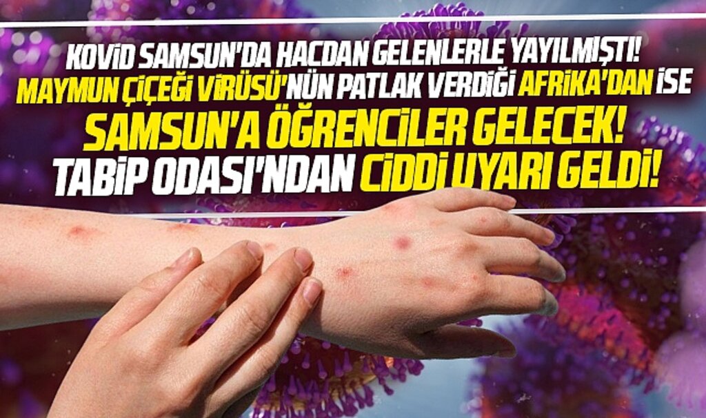 Samsun'a Afrika'dan gelecek öğrenciler için Maymun Çiçeği virüsü uyarısı yapıldı!