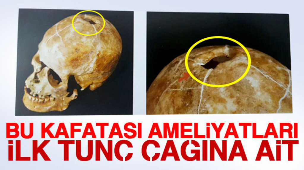İkiztepe Höyüğünde bulunan kafataslarında ki ameliyat izleri hayrete düşürüyor